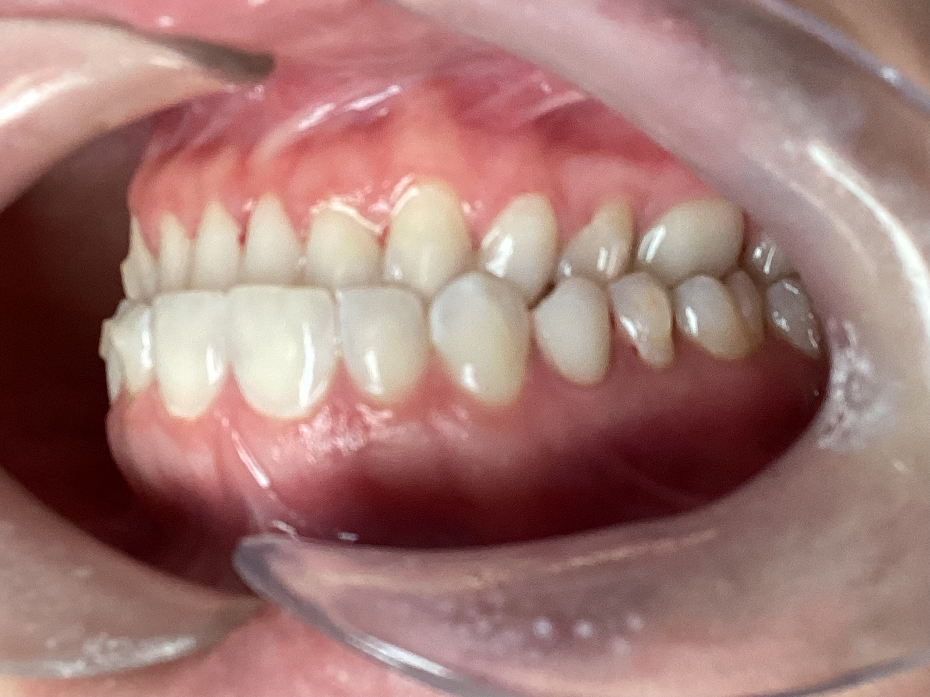 After Invisalign Treatment